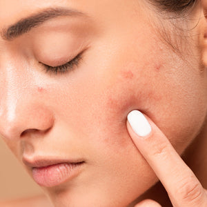 The 10 Best Natural Acne Treatments That Are Actually Effective-The Detox Market