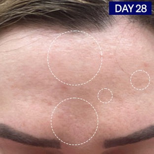 Odacite-Salicylic + Hyaluronic Acid Clarifying Serum-