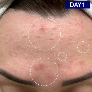 Odacite-Salicylic + Hyaluronic Acid Clarifying Serum-